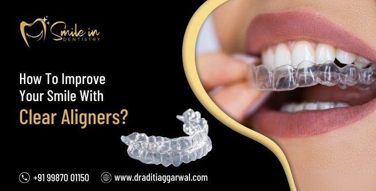 How to Improve Your Smile with Clear Aligners?