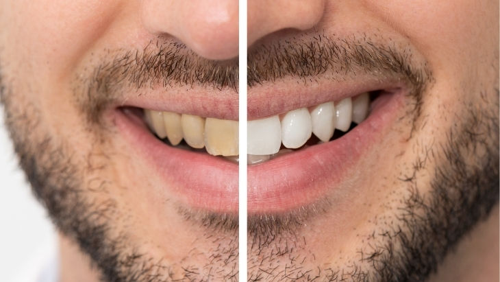 Teeth Whitening in Kandivali