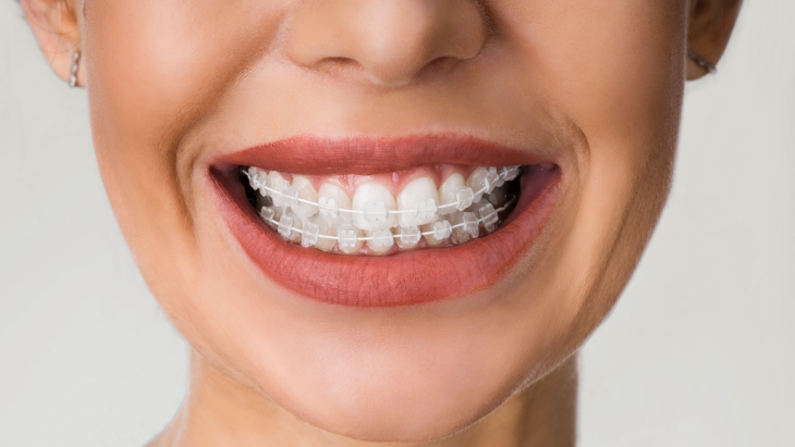ceramic braces in kandivali